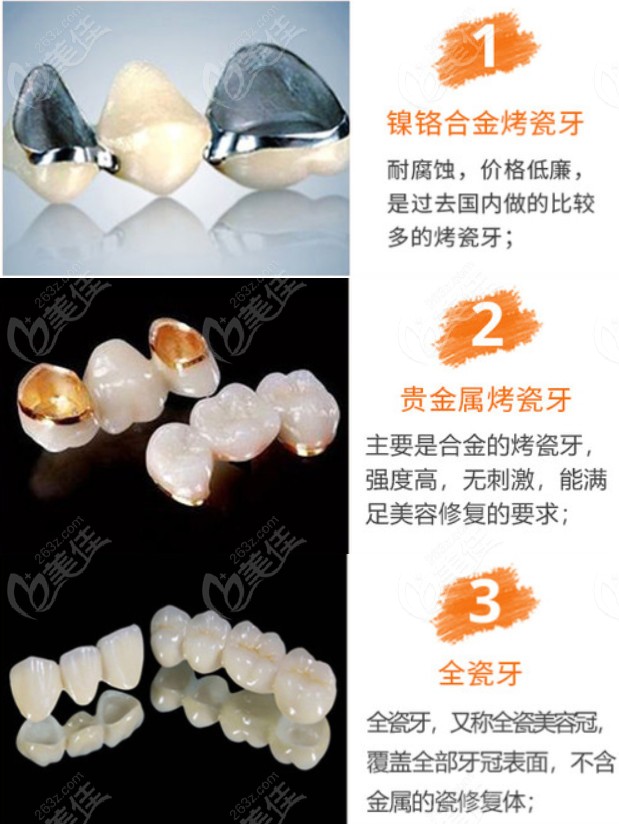 贵金属镶牙齿(镶金属牙好不好)