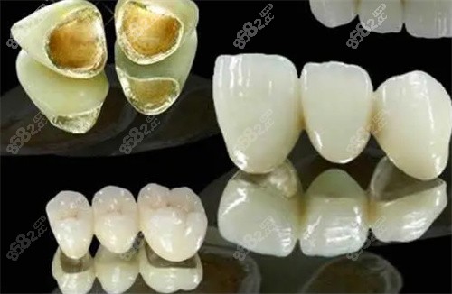 贵金属烤瓷牙的危害(贵金属烤瓷牙多少钱一颗)
