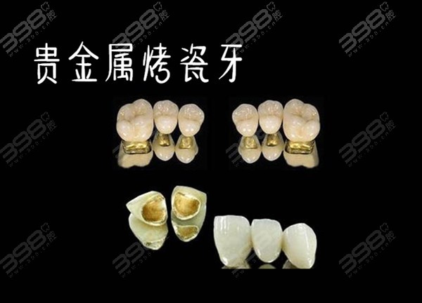 贵金属镶牙齿(镶牙后悔死了千万别种牙)
