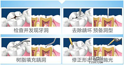 贵金属补牙(贵金属补牙能做磁共振吗)